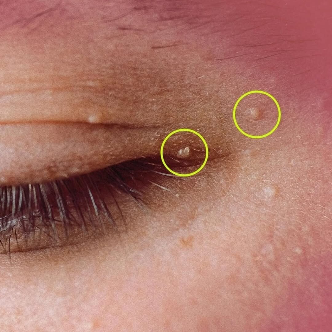 How to Get Rid of Milia: Safe Ways to Treat Those Tiny White Bumps 778835537_2366085047256976_2650802263021935932_n