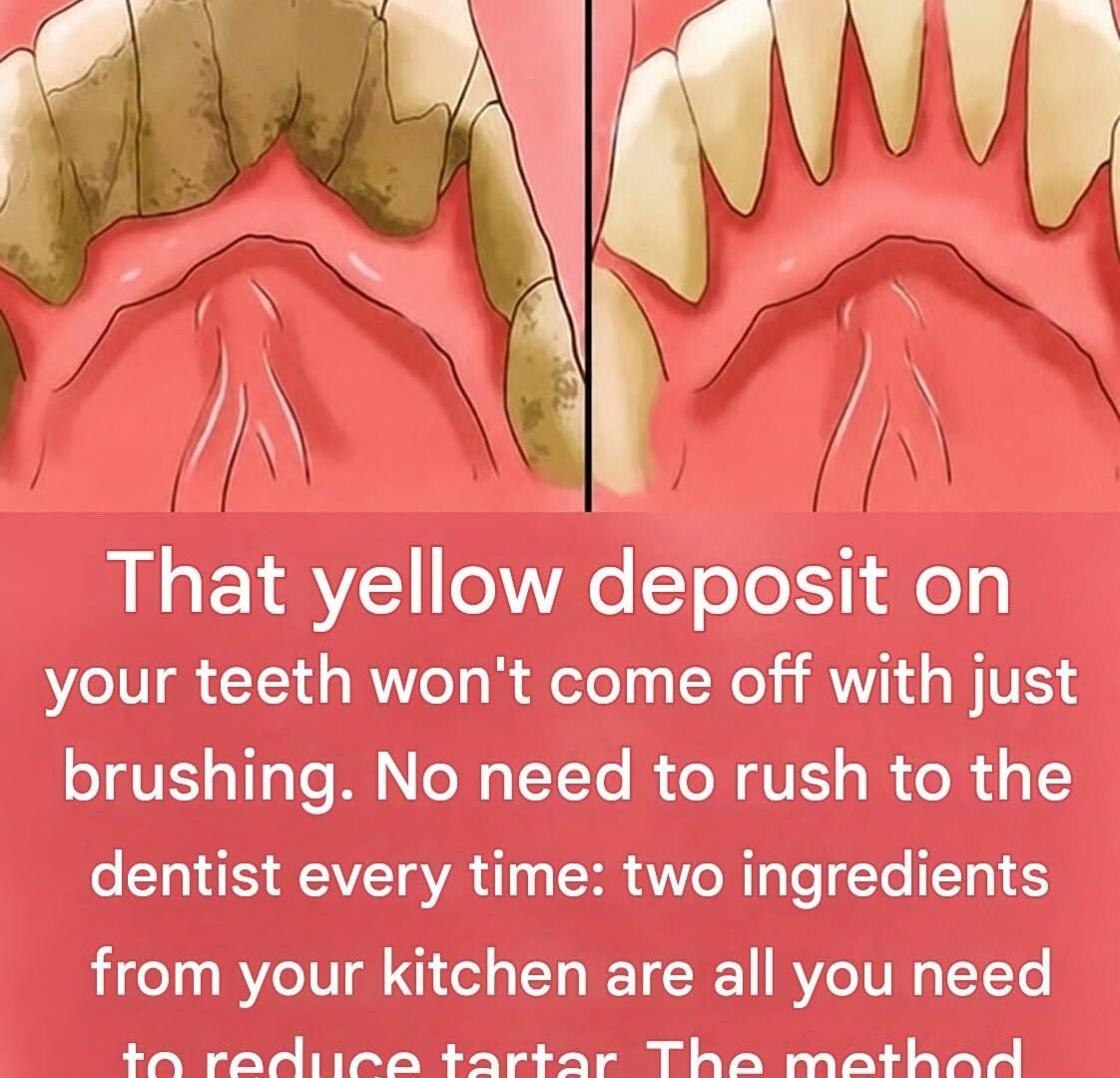 How to Deal With Tartar Buildup: What You Can Safely Do at Home 784394286_1569602094899760_6284502767069630030_n
