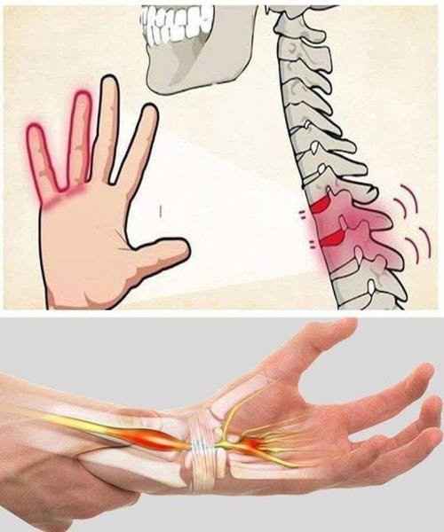 Why Your Hands Fall Asleep: The Warning Signs of Nerve Compression You Shouldn't Ignore 805784300_1388966643425370_7710724175912594243_n