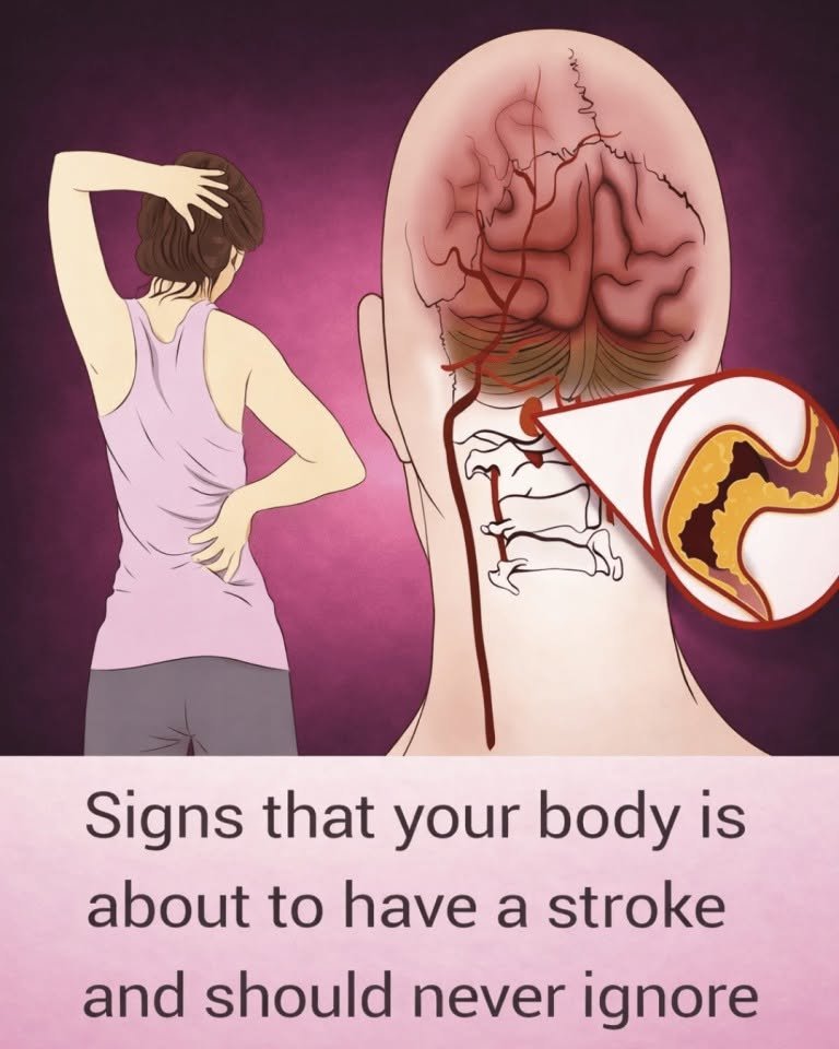 10 Early Warning Signs of a Stroke Everyone Should Know to Take Prompt Action 808883460_1095643546712893_179190565978683685_n