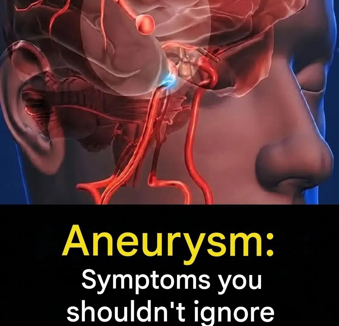 Aneurysm: 7 Critical Symptoms You Shouldn't Ignore 810623526_2311445172985832_9075787343144832911_n